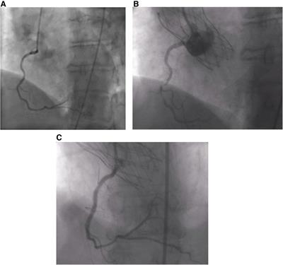 Case report: acute myocardial infarction in the setting of acute transcatheter aortic valve thrombus